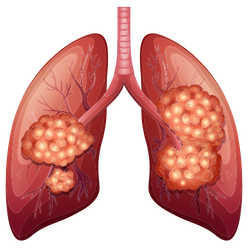 Lung Cancer