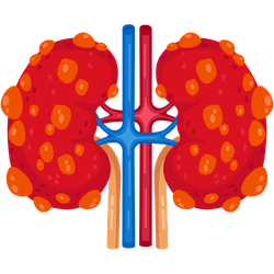 Kidney Cancer